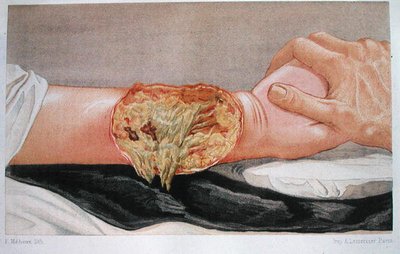 Krankenhausbrandwunde, aus 