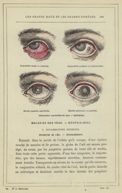 Oberflächliche Augenentzündungen, Ophthalmien von French School