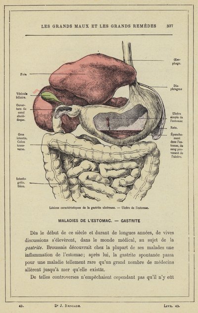 Charakteristische Läsionen der ulzerösen Gastritis, Magengeschwür von French School