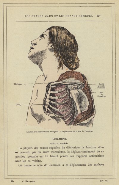 Luxation unter dem Rabenschnabelfortsatz der Schulter, Verlagerung des Humeruskopfes von French School