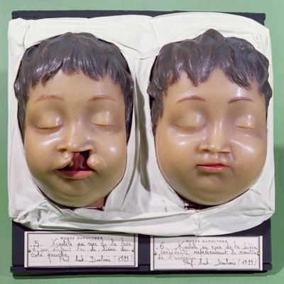 Modell, das ein Kinder Gesicht vor und nach einer Operation zur Korrektur einer Hasenscharte zeigt, durchgeführt von Antoine Dubois (1756-1837) im Jahr 1799 (Wachs) von French School
