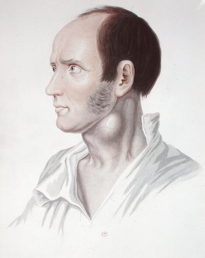 Patient mit einem Aneurysma, aus 