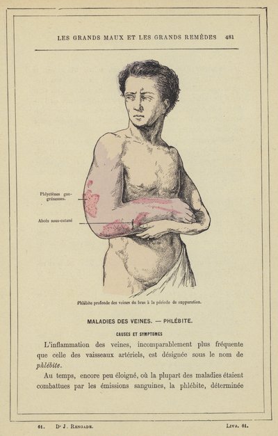 Tiefe Phlebitis der Armvenen in der Eiterungsphase von French School