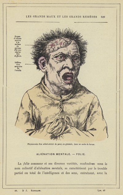 Physiognomie eines Geisteskranken mit allgemeiner Lähmung in einem Wutanfall von French School