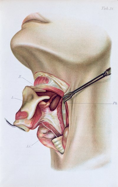 Tafel aus Atlas und Epitome der operativen Chirurgie von Dr. Otto Zuckerkandl (1861-1921) 1910 von French School