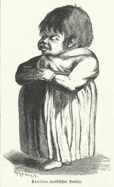 Kretin, Frau mit angeborenem Jodmangelsyndrom (Gravur) von German School