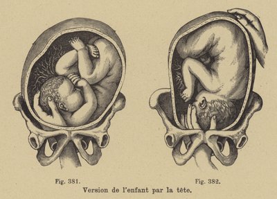 Drehen eines Babys im Mutterleib, sodass der Kopf vor der Geburt nach unten zeigt von German School
