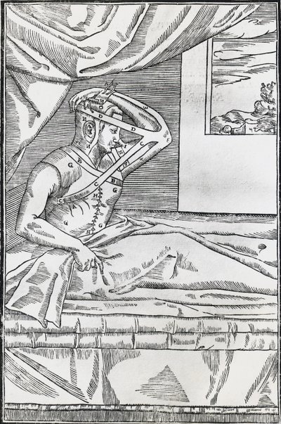 Rhinoplastik-Operation, bei der die Nase des Patienten an eine Hautklappe am Oberarm angeschlossen wurde von Italian School
