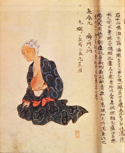Die erste chirurgische Behandlung von Brustkrebs unter Vollnarkose durchgeführt von Seishu Hanaoka (1760-1836) im Jahr 1804 von Japanese School