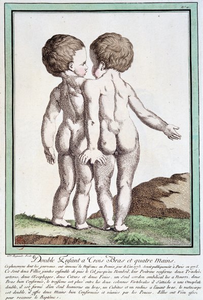 Siamesische Kinder - in „Die Abweichungen der Natur“ von Régnault von Jean Baptiste Regnault