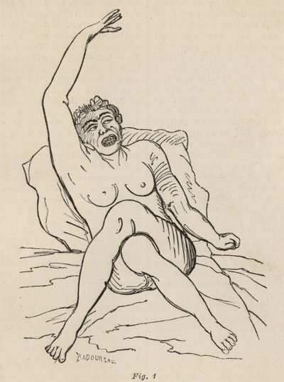 Hysterische Epilepsie, Anfall, Verrenkungen, Abb. 1 aus 