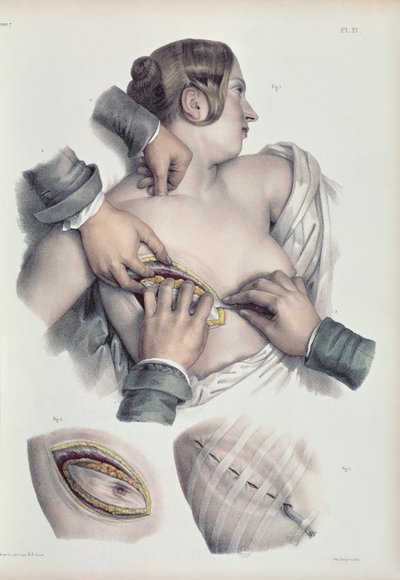 Operation eines krebsartigen Tumors, aus 