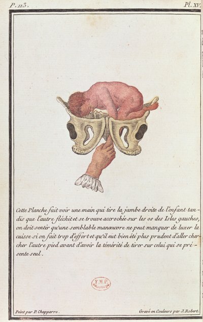 Querschnittsdiagramm eines Babys, das am Arm aus dem Mutterleib gezogen wird, aus einem Buch von Madame Angelique Le Boursier du Coudray, graviert von J. Robert, 1783 von P. Chapparre