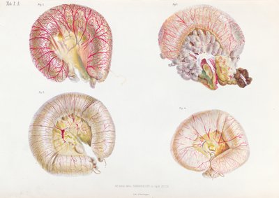 Die äußere Oberfläche der mit Cholera infizierten Eingeweide, aus Anatomie Pathologique du Cholera Morbus, von Nikolai Ivanovich Pirogov (1810-81) veröffentlicht in St. Petersburg, 1849 von Russian School