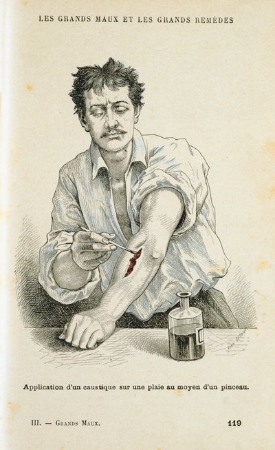 Eine Wunde mit einer antiseptischen Lösung behandeln, um 1890 von Unbekannt