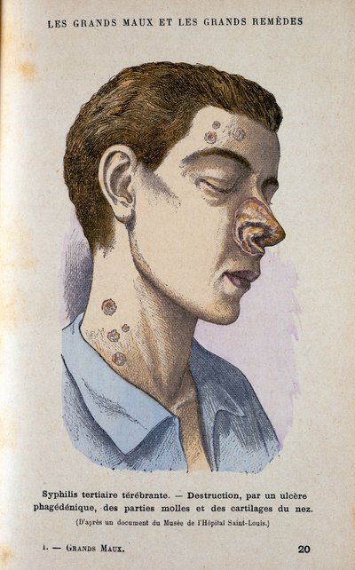 Symptome der tertiären Phase der Syphilis, 19. Jahrhundert von Unbekannt