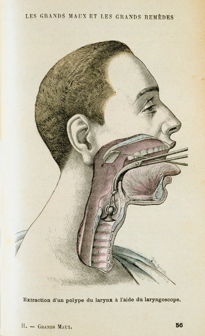 Verwendung eines Laryngoskops zur Entfernung eines Polypen aus dem Hals, ca. 1890 von Unbekannt