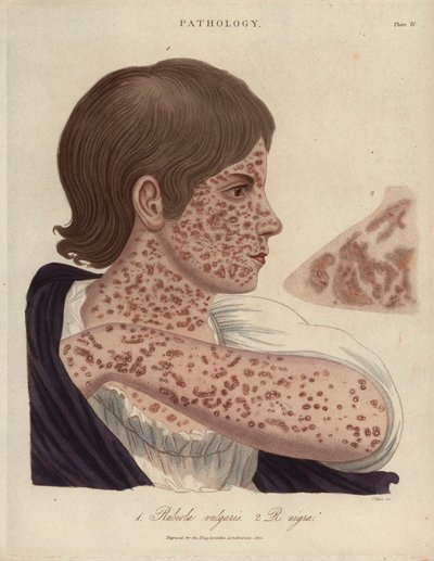 Masern und Röteln - Lithographie von John Pass, veröffentlicht in „Encyclopedia Londinensis“ von John Wilkes, Ausgabe J.Adlard, London von Unbekannter Künstler