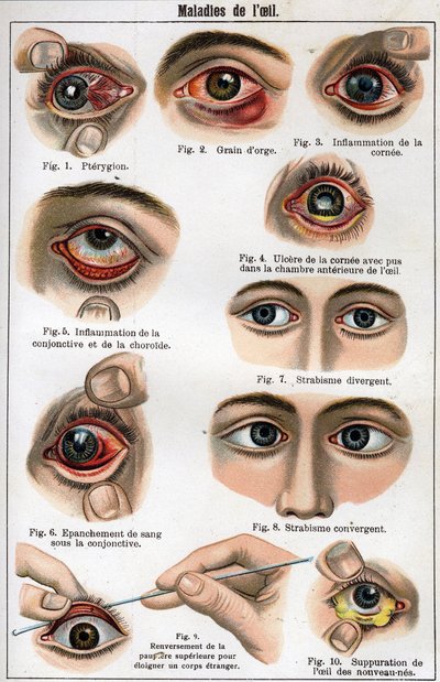 Augenkrankheiten. In „Die neue natürliche Heilung“ von F.E. Bilz. von Unknown artist