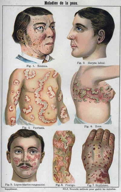 Hautkrankheiten: Ekzeme, Lippenherpes, Psoriasis, Gürtelrose, Lupus, Prurigo, Erythem. In „Die neue natürliche Heilung“ von F.E. Bilz. von Unknown artist