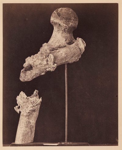 Leutnant Goodwin, verstorben, nicht vereinigte Schussfraktur des oberen Drittels des rechten Oberschenkels, sieben Monate nach der Verletzung, aus dem fotografischen Katalog der chirurgischen Abteilung von William Bell