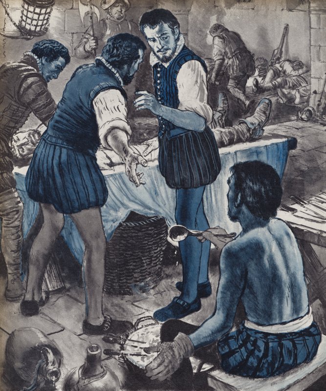 Ambroise Paré, Militärchirurg, als das Öl ausging von English School