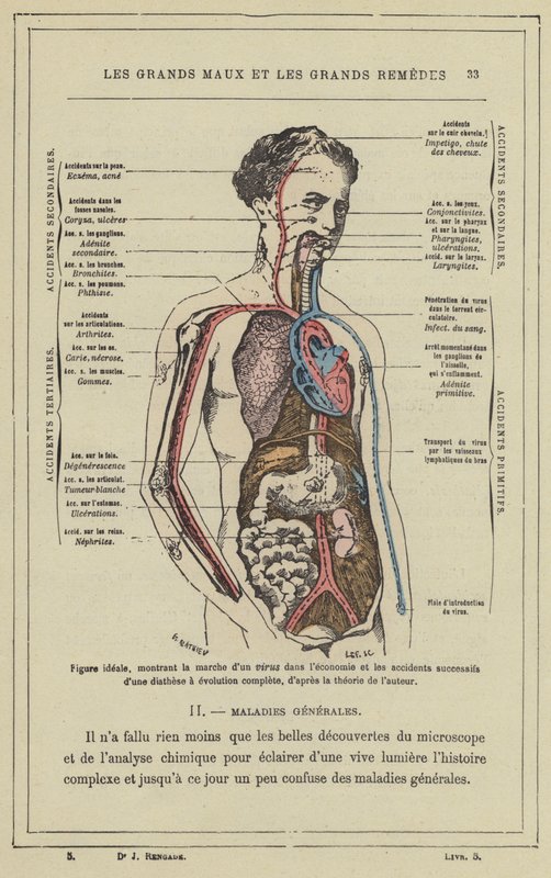 Ideale Figur, die den Verlauf eines Virus im Körper und die aufeinanderfolgenden Unfälle einer vollständigen Diathese zeigt, nach der Theorie des Autors von French School