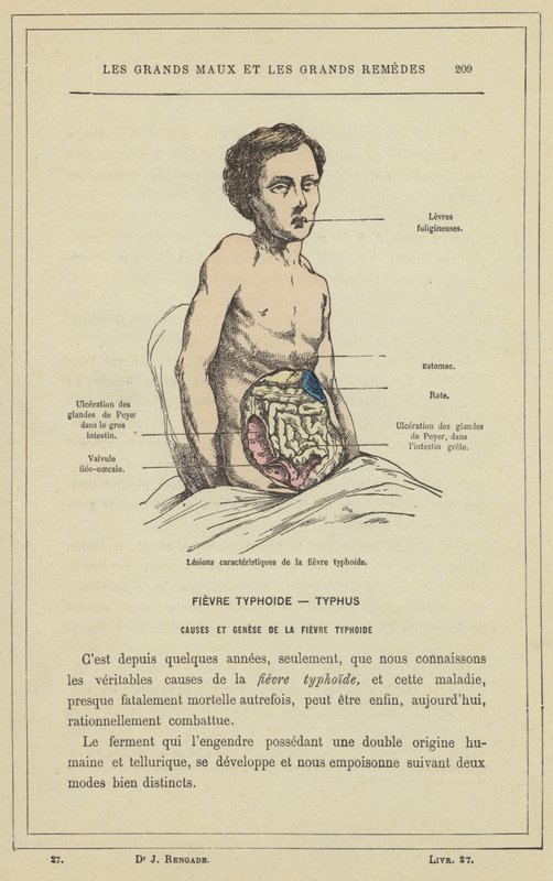 Charakteristische Läsionen des Typhus von French School
