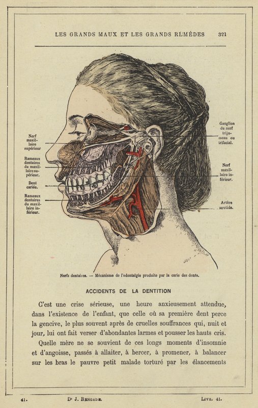 Zahnnerven, Mechanismus der Zahnschmerzen durch Karies von French School