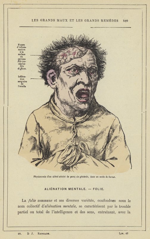 Physiognomie eines Geisteskranken mit allgemeiner Lähmung in einem Wutanfall von French School