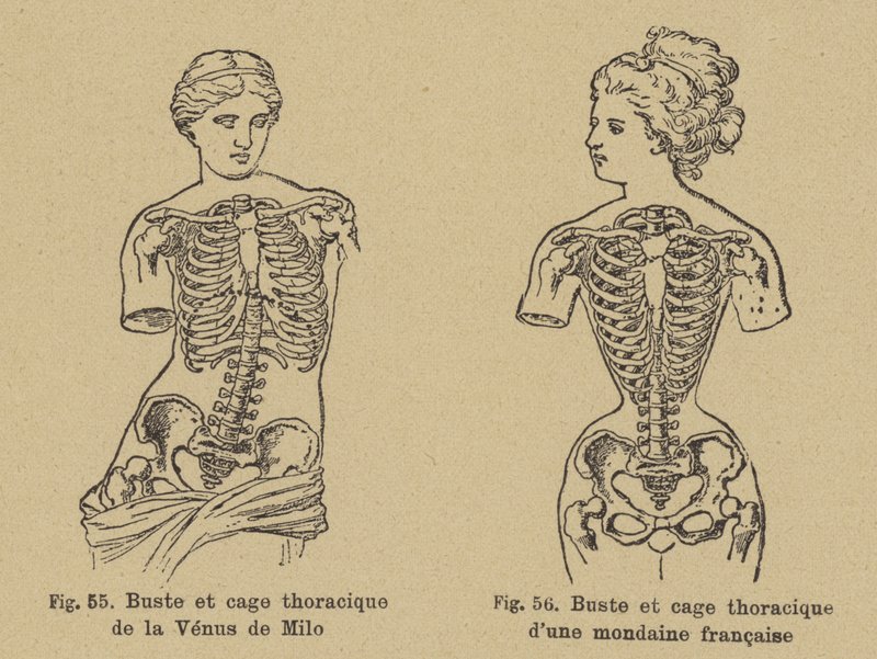 Vergleich der Brust- und Rippenform der Venus von Milo mit der einer französischen Gesellschaftsdame des späten 19. Jahrhunderts von German School