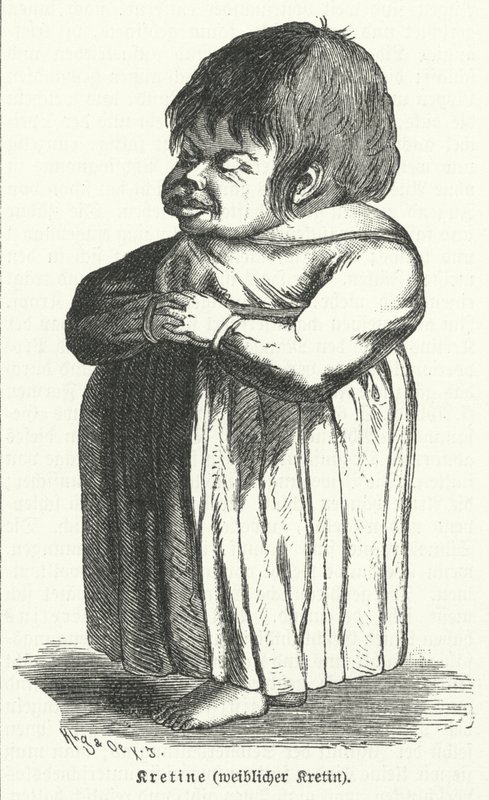 Kretin, Frau mit angeborenem Jodmangelsyndrom (Gravur) von German School