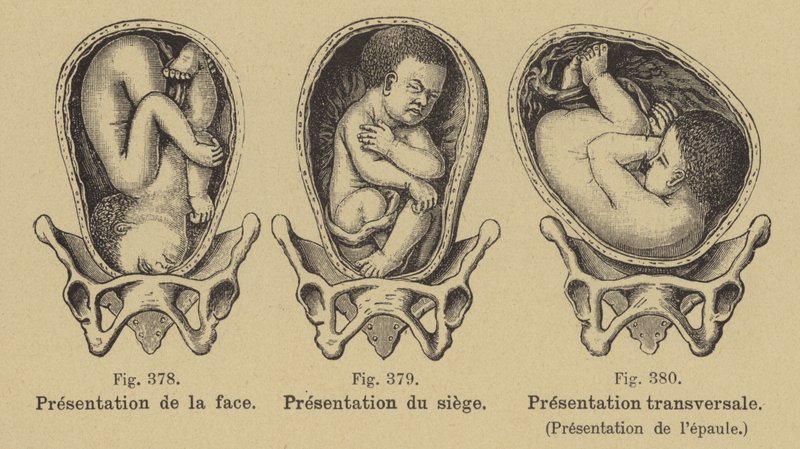 Fehllage von Babys im Mutterleib vor der Geburt von German School