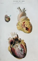 Tafel, die Herzkrankheiten darstellt. Spontaner Herzriss einer 86-jährigen Frau (Abb. 1) und Perikarditis bei einem sechs Tage alten Baby (Abb. 2), aus 