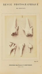 Mehrfache und symmetrische Exostosen, Femur, Tibia