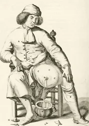 Abfluss von Flüssigkeit aus einem Abszess, aus Exercitationes Practicae circa Medendi Methodum von Frederik Dekkers, 1694