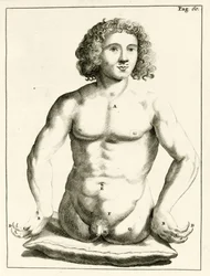 Beispiel für angeborene Geburtsfehler, aus Exercitationes Practicae circa Medendi Methodum von Frederik Dekkers, 1694