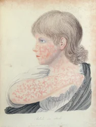 Röteln, Illustration für ein Buch von Robert Willan (1757-1812), 1808