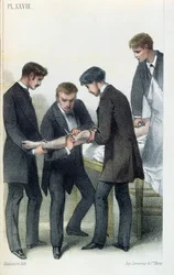 Amputation eines Arms, aus einem medizinischen Handbuch von Jean-Baptiste-Leon Dubreuil, ca. 1850-60
