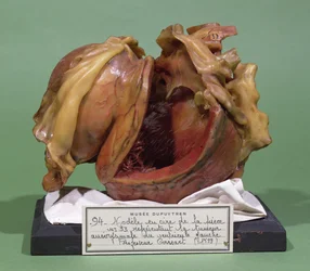 Modell eines Tumors des linken Ventrikels, 1799
