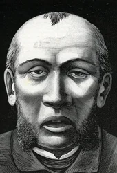 Patient mit Gehirnerweichung (Gravur) 1888