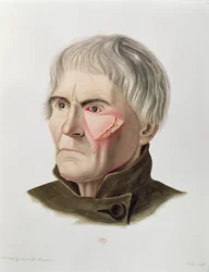 Hauttransplantationsoperation, aus Selecta Praxis Medico-Chirurgica von Alexander Auvert, Paris, 1856