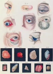 Beschreibung angeborener Augenanomalien, aus Klinische Darstellungen der Krankheiten und Bildungsfehler des menschlichen Auges, von Friedrich August von Ammon (1799-1861) 1838