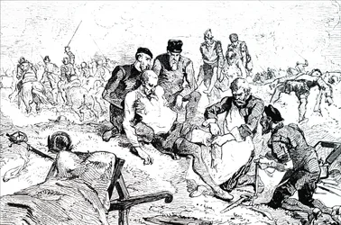 Ambroise Paré bindet Arterien nach einer Amputation ab.