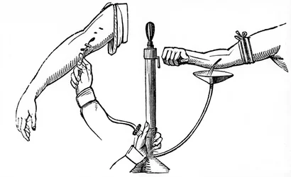 Person-zu-Person-Bluttransfusion, 1833