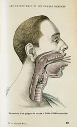 Verwendung eines Laryngoskops zur Entfernung eines Polypen aus dem Hals, ca. 1890