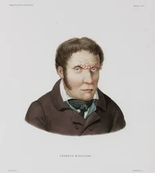 Krankheiten, Lepra