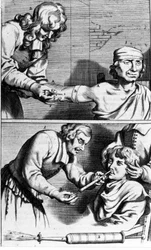 Blutung und Nasendusche von Johannes Sculpteti „Armamentarium Surgery“ Amsterdam 1672