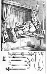 Klistier (für Einläufe) von Johannes Scultetus „Armamentarium Chirurgicum“. Venedig 1665