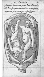 Die Position des Fötus im Uterus während der Schwangerschaft. Gravur aus „De la generation des enfants“ von dem französischen Arzt und Chirurgen Ambroise Paré (1509-1590) 16. Jahrhundert